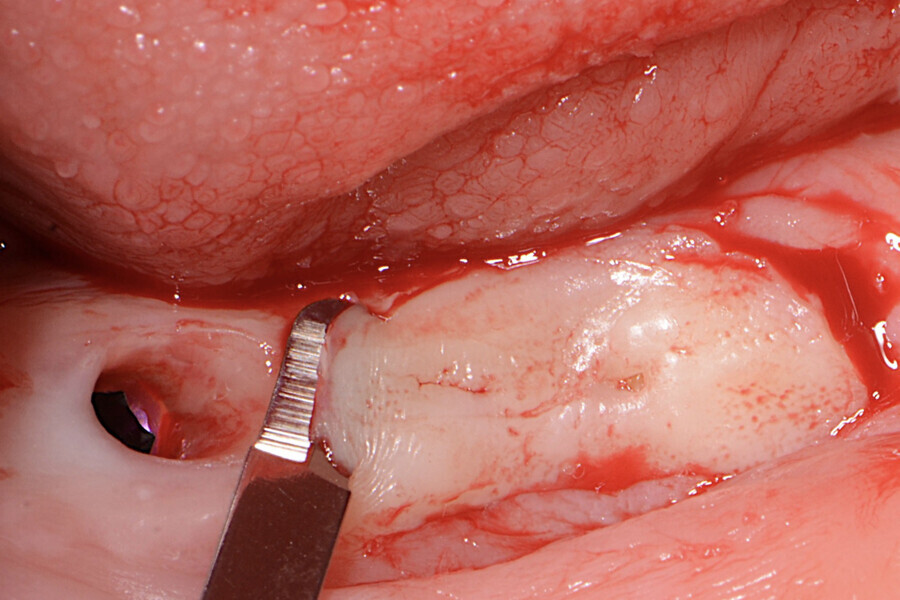 Fig.4 : Incision des bords du lambeau et désépithélialisation.