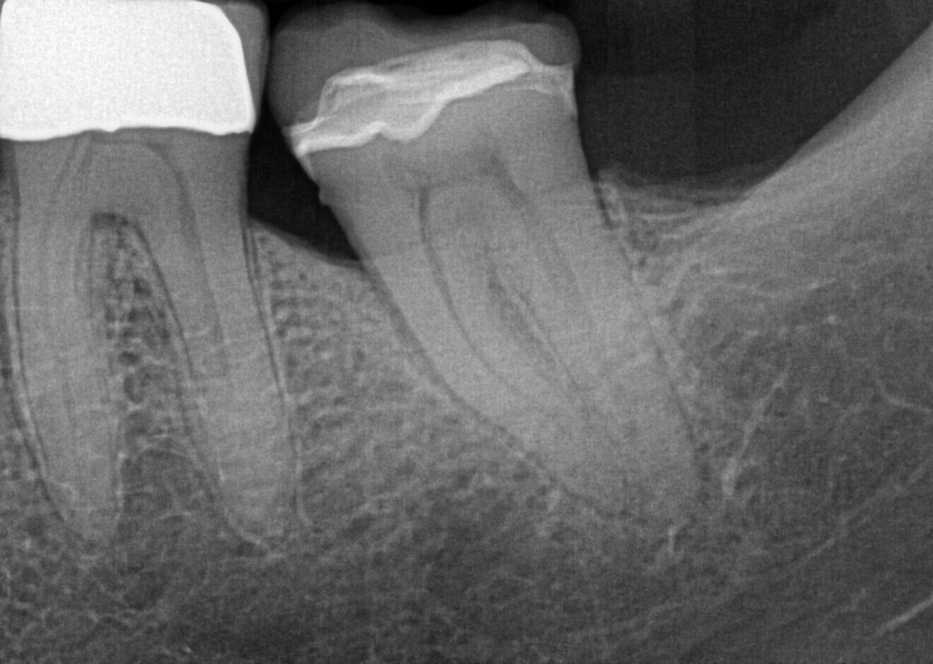The pre-op radiograph shows tooth #37, which had been treated with a ceramic restoration two years earlier after removal of deep caries, diagnosed with irreversible pulpitis and periapical periodontitis. (Image: Dr Sabine Remensberger) 
