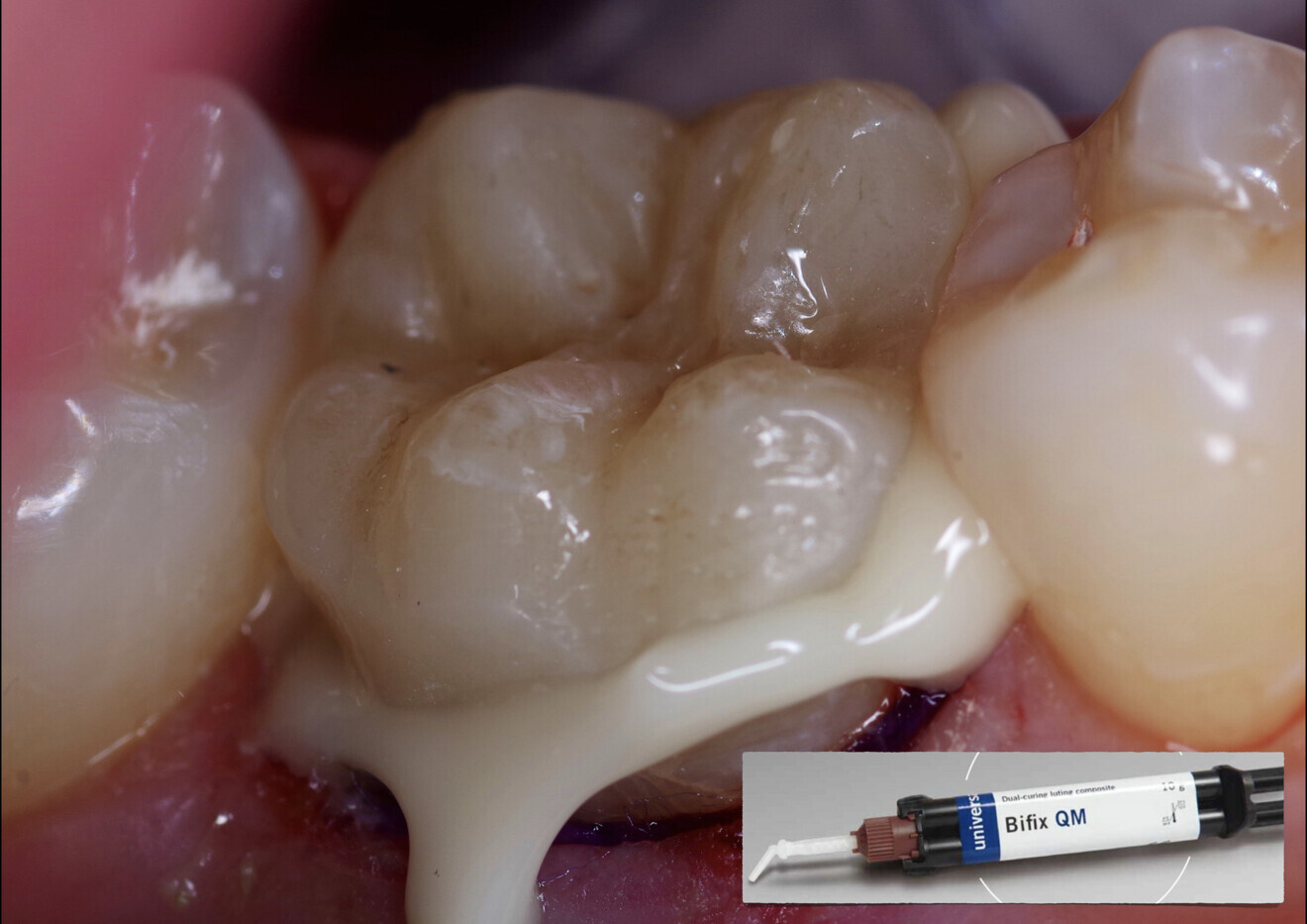 Fig. 20: Cementation of the restoration with Bifix QM after acid etching, rinsing and drying of the tissue and core build-up composite and application of Futurabond U.