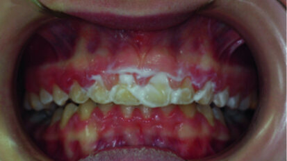 Application of a topical anaesthetic.