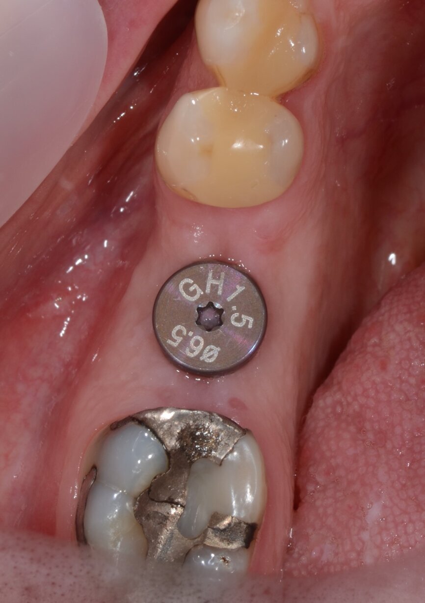 Fig. 7: Healing abutment in position, occlusal view.