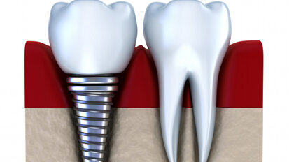 Zahnimplantate so sicher wie nie zuvor Zahnimplantate so sicher wie nie zuvor