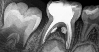 Traitement endocanalaire de molaires temporaires nécrosées — au moyen d’un système de lime unique à mouvement alternatif