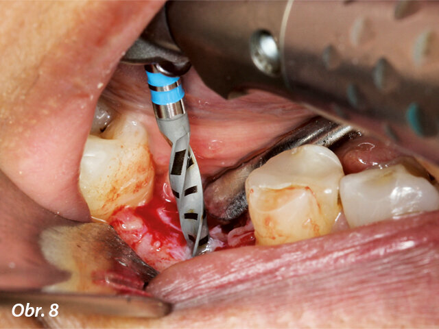 Úvodní osteotomie byla provedena vrtákem průměru 2,2 mm.