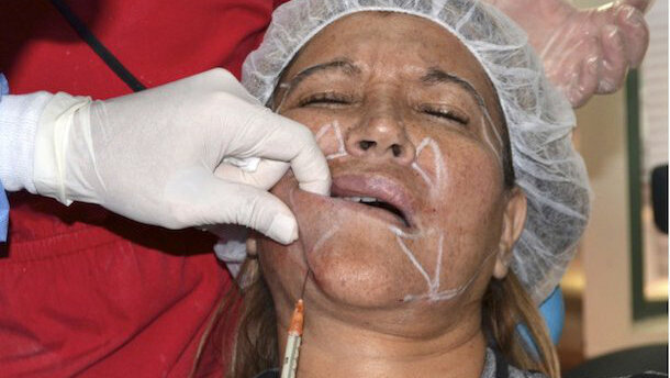 El rejuvenecimiento facial con ozono