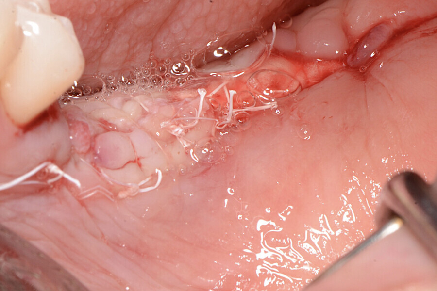 Fig. 14 : Situation immédiatement après l’intervention.