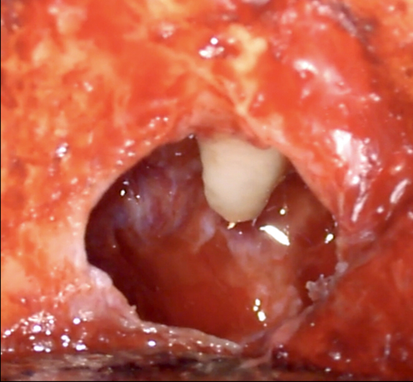 Fig. 4d: Removing the cyst from around the root without damaging the surface, followed by surface treatment of the exposed part of the root.