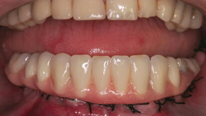 The ‘All-on-4’ implant concept for edentulous jaws