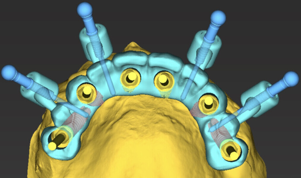 Fig. 13a: Provisional prosthesis inserted with anchor pins design ...