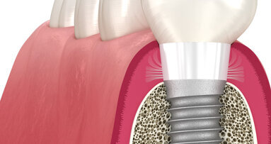 Livre blanc : comment favoriser une adhésion tissulaire naturelle en implantologie ?