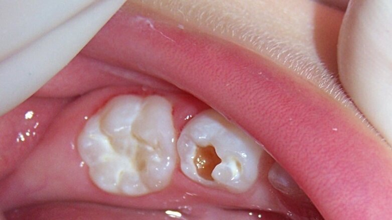 Mínima Intervención en Odontopediatría