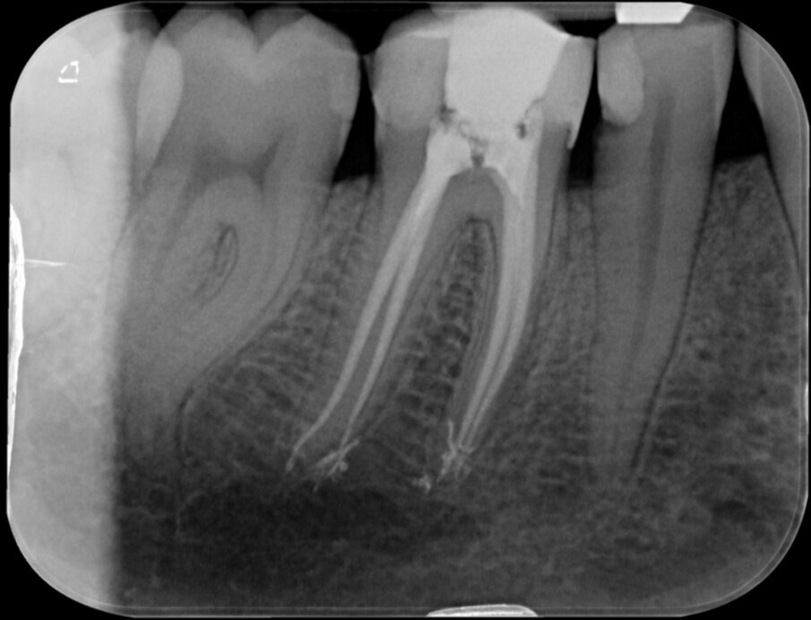 Afbeelding 3. Er lijkt sprake van een gevuld systeem.