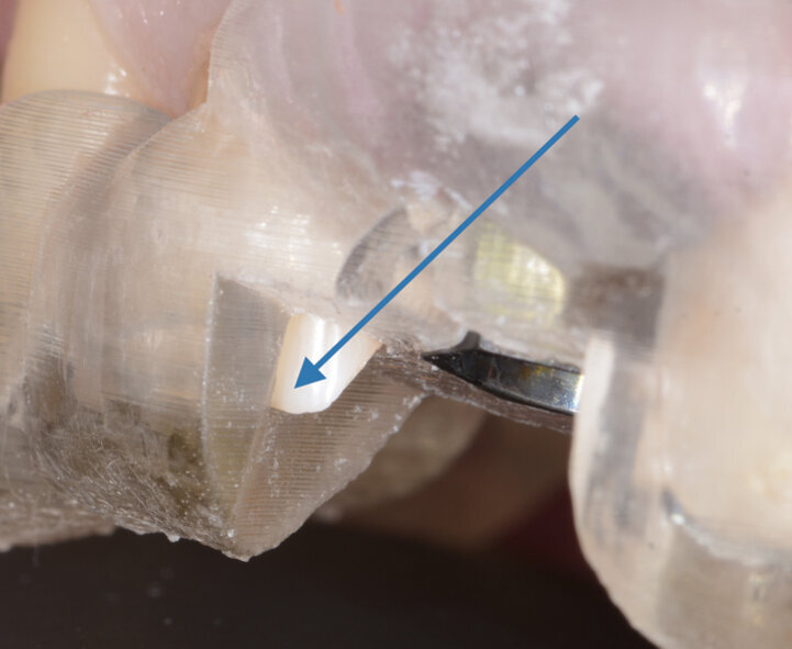 Fig. 13: The guide fitted flawlessly on the patient’s teeth. 