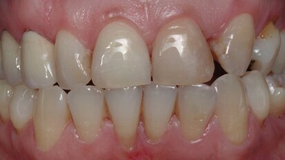 Rehabilitación bucal estética con asistencia de ortodoncia