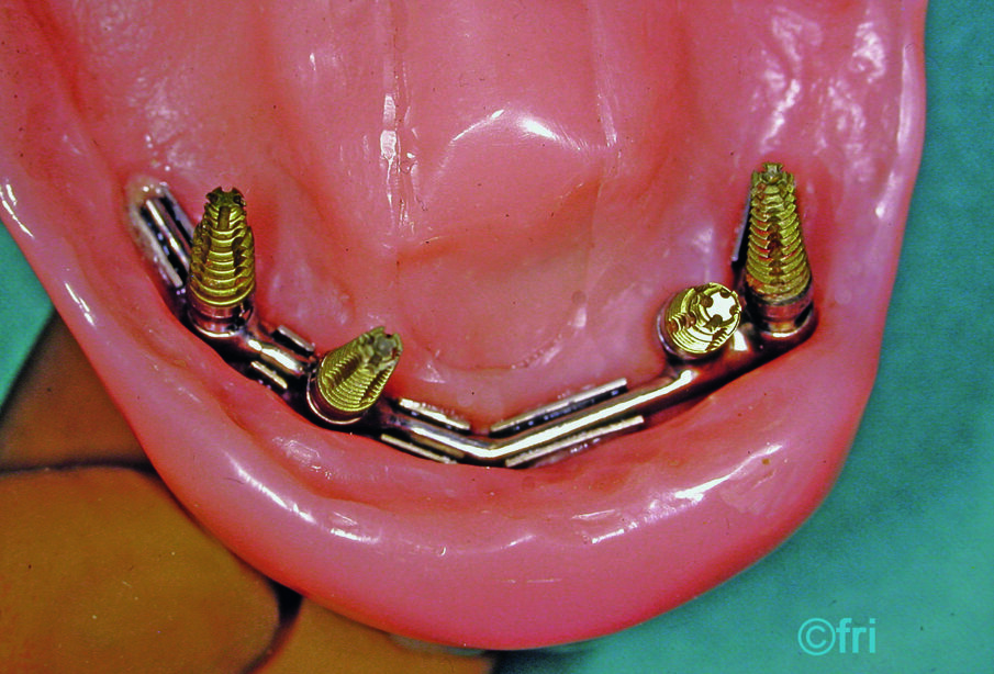 Fig. 2: Recesses underneath a mandibular prosthesis supported by an implant bar.
