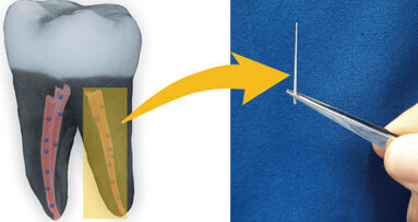 Nanodiamonds might prevent tooth loss after root canals