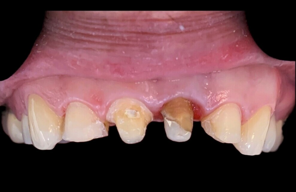 Fig. 4: Clinical situation just before placement of the definitive restoration.
