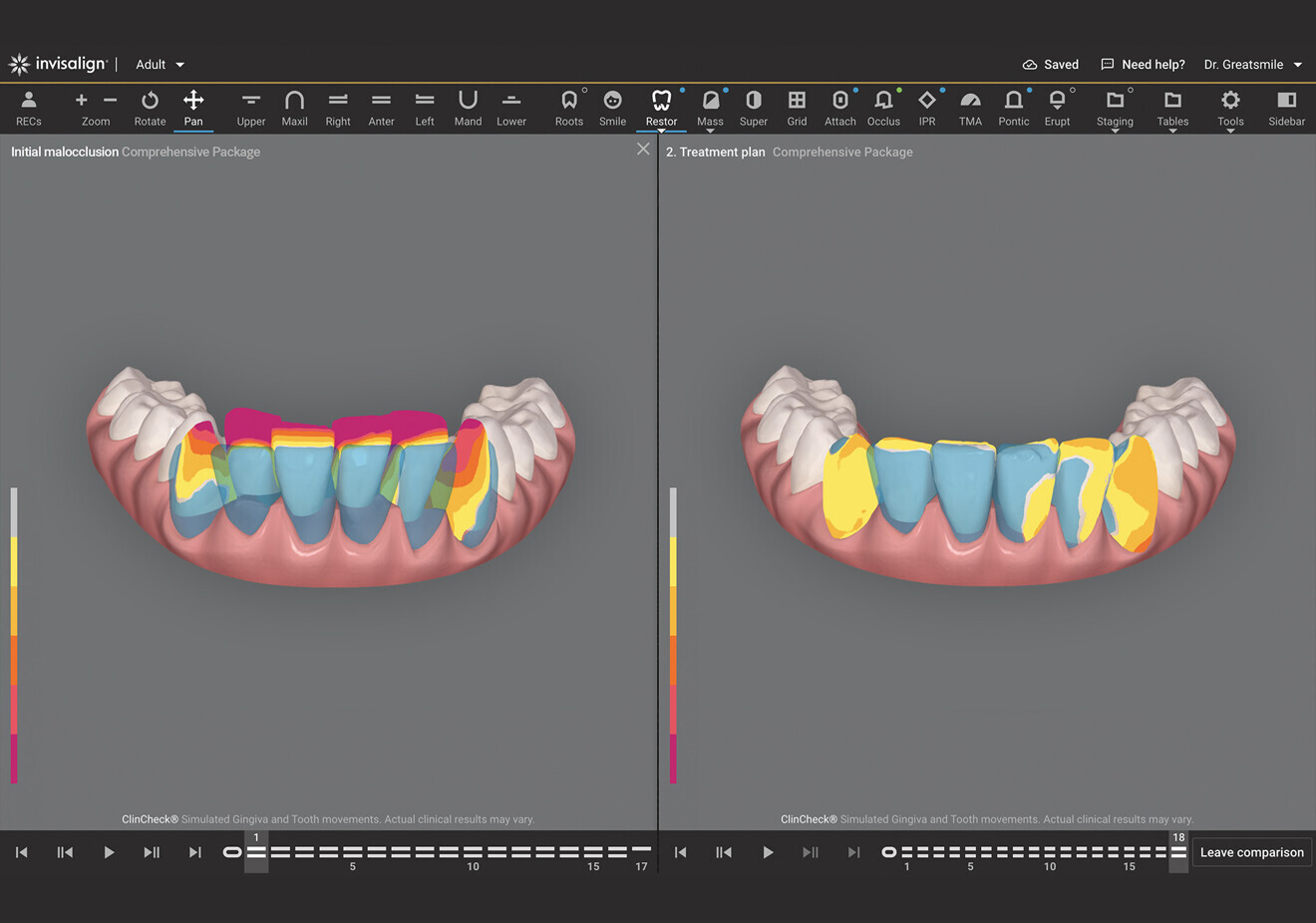 Invisalign Smile Architect helps dental professionals achieve high-quality clinical outcomes through optimised digital planning tools.