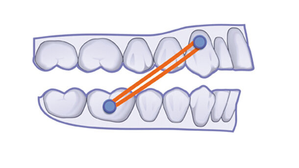 El protocolo clínico CA® CLEAR-ALIGNER y por qué es así