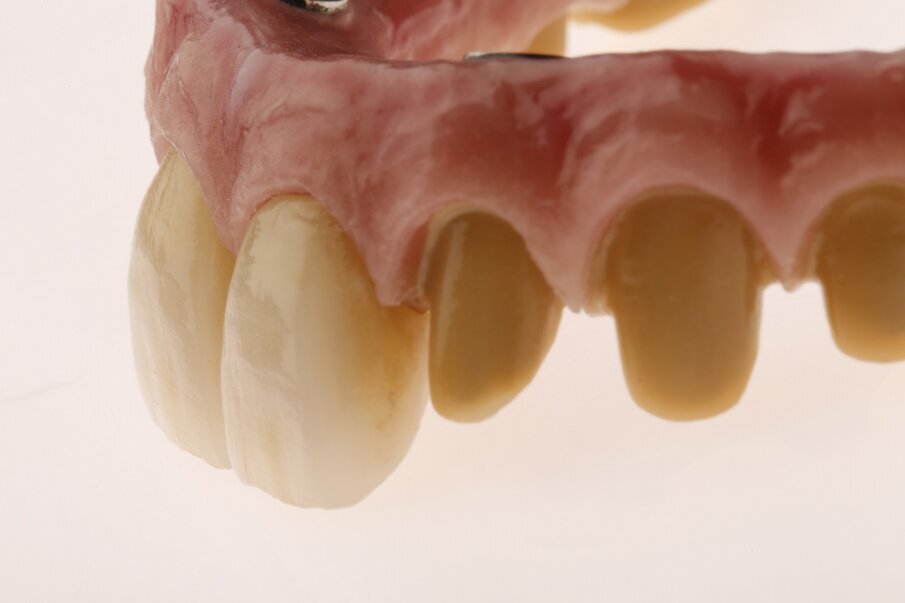 Fig. 17: Perfect integration of the pink and white parts after mechanical polishing.