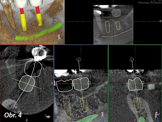 Byl jsem schopen dosáhnout nejlepší bukální a lingvální pozice implantátů i jejich vzájemného vztahu  a vztahu vůči sousedním zubům