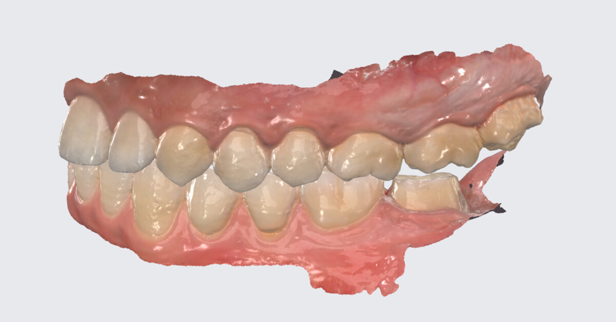 AI chairside crown design reduces manual work in single posterior case