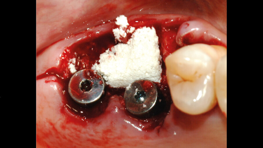 Fig. 5 - Applicazione della pasta ossea liofilizzata (Bio-Gen Putty, Bioteck Spa) a secco. Si idrata con il sangue del paziente, diventando malleabile e adattandosi per riempire il gap tra impianto e osso alveolare. Avvitamento delle viti di guarigione.