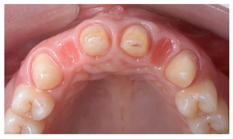Fig. 27_Visione occlusale dei tessuti dopo la rimozione del provvisorio.
