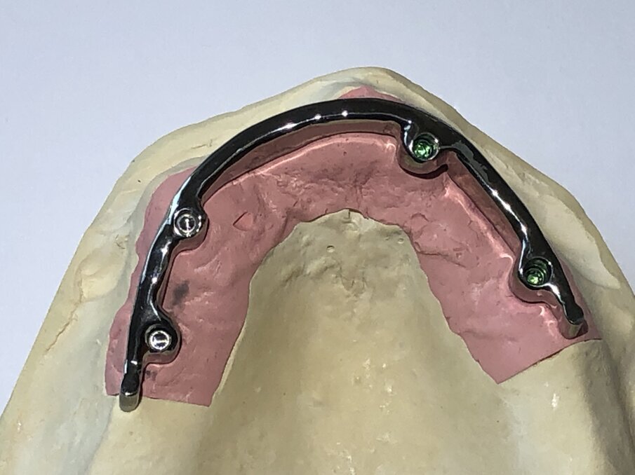 Afbeelding 13. CAD CAM gefreesde staafconstructie (palatinaal).