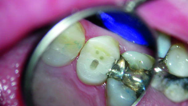 Fibre posts and tooth reinforcement: Evidence in the literature
