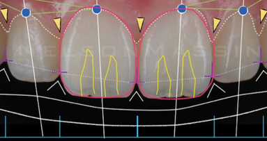 Curso intensivo práctico de carillas cerámicas y poliméricas