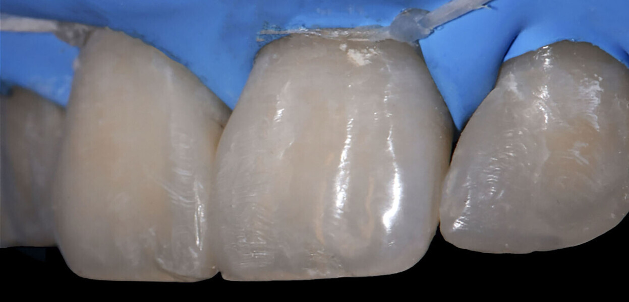 Fig. 15b: Control of restoration.