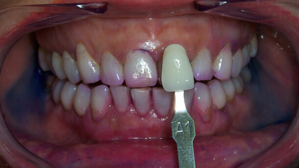 Nuove tecnologie cosmetiche di sbiancamento per il mantenimento di un sorriso estetico