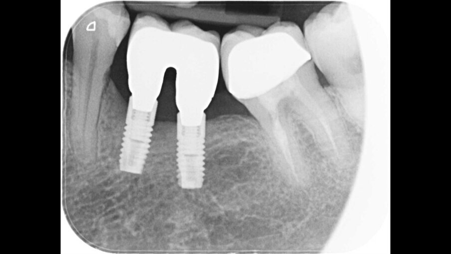Fig. 9 - La radiografia di controllo ad un anno dal trattamento evidenzia il riempimento del difetto angolare.