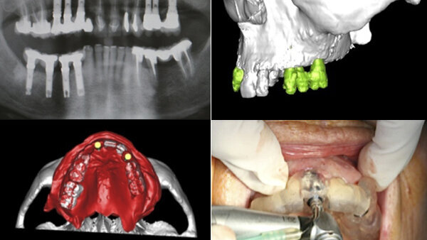 Precisión en cirugía guiada por ordenador
