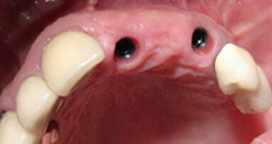 Screw-retained, implant-supported fix partial denture (FPD)