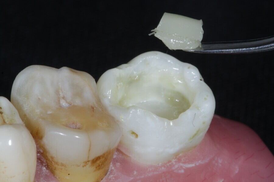Fig. 25b: Fibre-reinforced membrane cube containing fibre membrane within the composite resin material (Fibrafill CUBE).