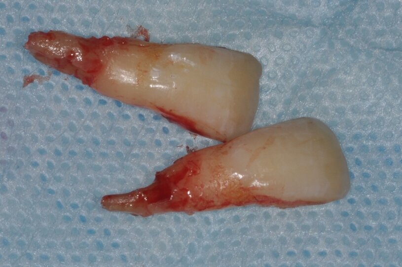 Ryc. 3_Zęby 11 i 21 po ekstrakcji.