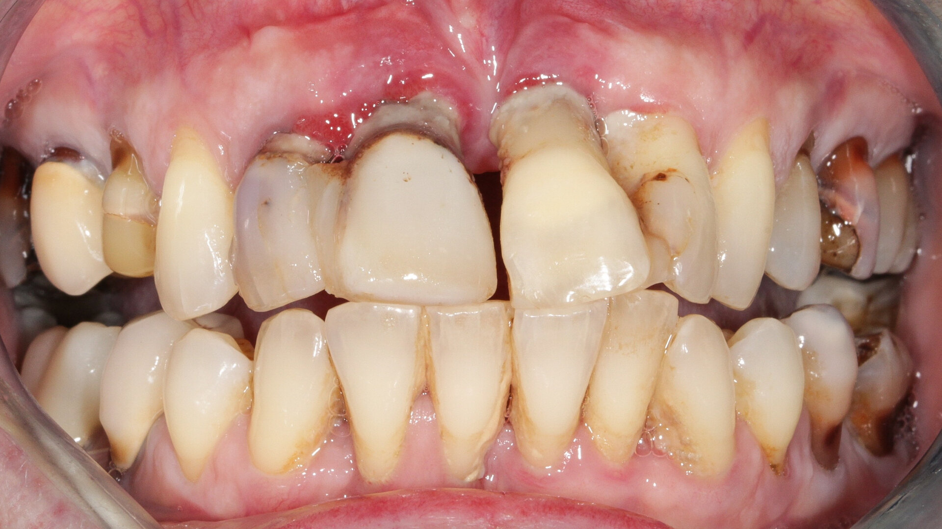 Greffons radiculaires : traitement des défauts osseux antérieurs par racines dentaires ankylosées