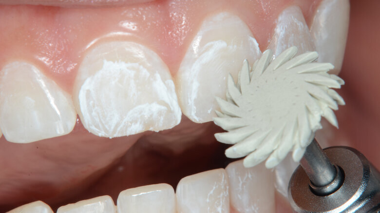 Foto 8. Pulido con ruedas Jiffy Natural (color amarillo y blanco) y pasta diamantada de 1 y 0,5µ.
