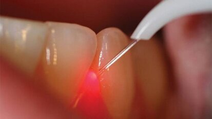 Na ogen nu ook tanden laseren