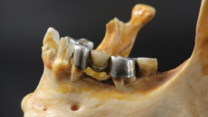 Nowy materiał pomoże w leczeniu zakażeń kości