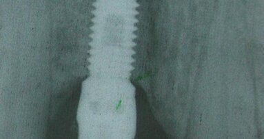 La Distrazione Alveolare. Interesse nel ripristino o la preservazione dell'estetica dei settori anteriori