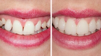 Von der Planung bis zur Realisierung: Experte referiert über Adhäsiv-Verfahren Von der Planung bis zur Realisierung: Experte referiert über Adhäsiv-Verfahren