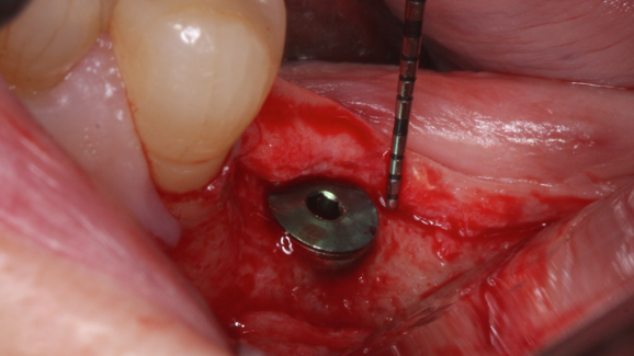 Vertical reconstruction of peri-implant soft tissue