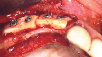 Horizontální augmentace kosti