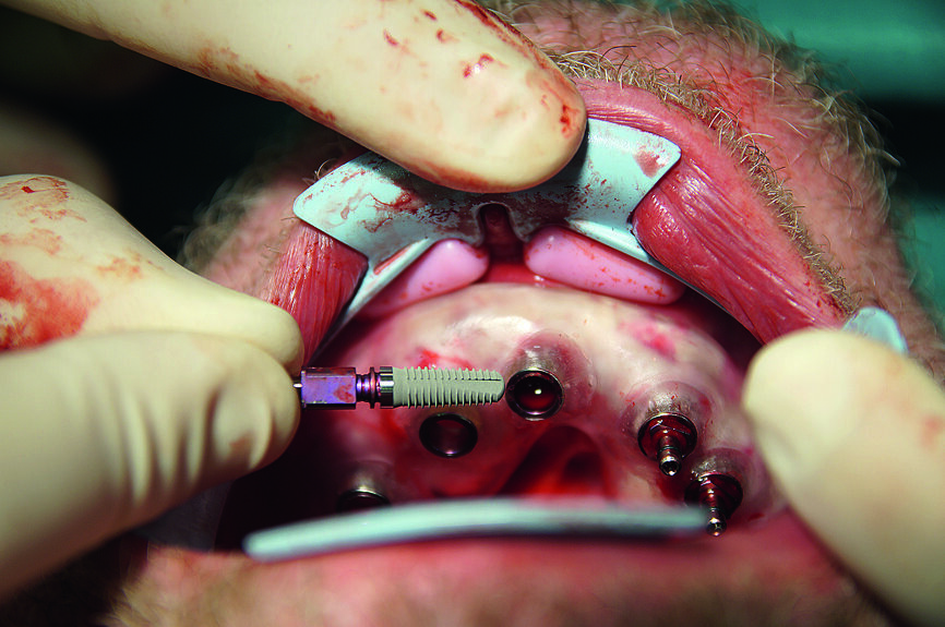 Fig. 16 : Pose des implants. 