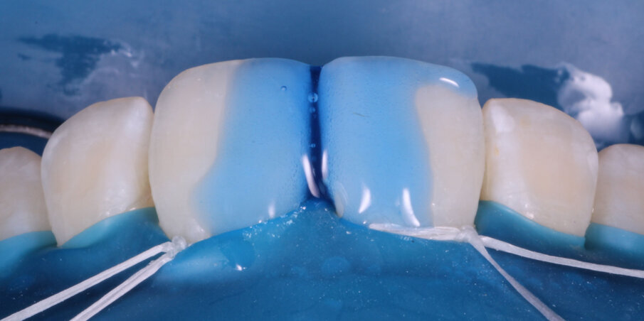 Fig 5. Etch with 37% Phosphoric Acid