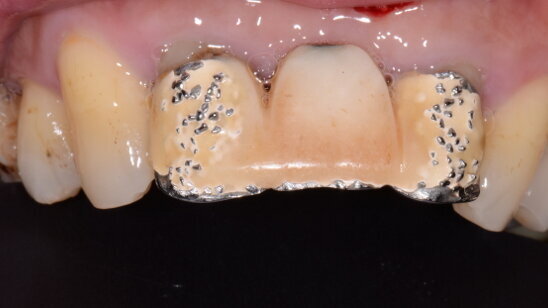 Laser diode et microchirugie