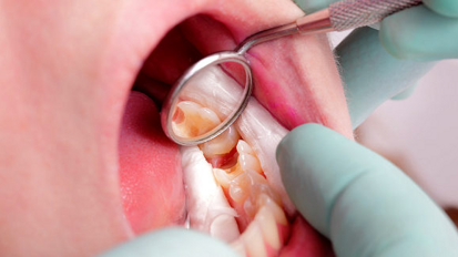 Европейските експерти се обединяват, за да спрат кариеса